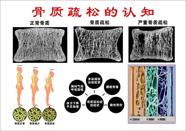 健康体重，强骨健身：构筑骨骼一生的坚固防线——写在第28个世界骨质疏松日之际